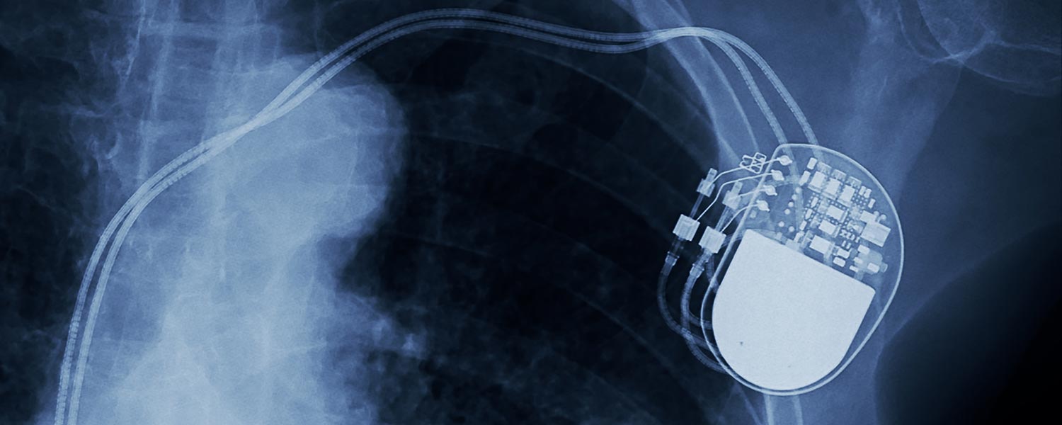 Анемия 2024. Имплантация кардиостимулятора. Экран кардиостимулятор. Временные кардиостимуляторы. Кардиостимулятор сердца установка пожилым цена.